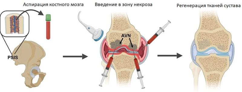 BMAC-терапия в МЦ Артролиге