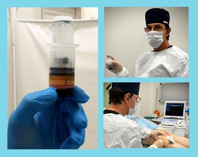 Год успешного применения SVF-терапии в лечении артроза