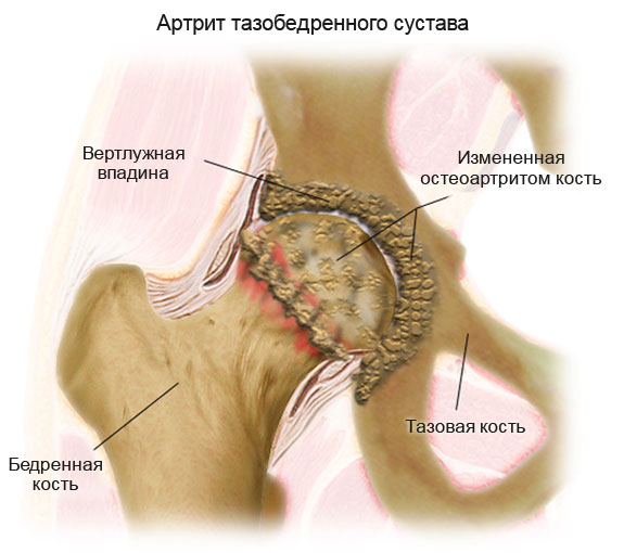 Лечение артроза тазобедренного сустава